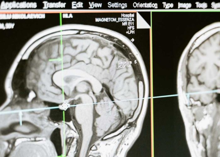 Se estima que a Estados Unidos le cuesta 635 mil millones de dólares cada año la atención médica y pérdida de productividad por incapacidad, cifras reveladas en el boletín de prensa de Abbott (Imagen: pexels.com)